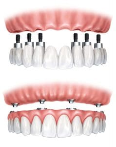 Implant supported bridge or dentures