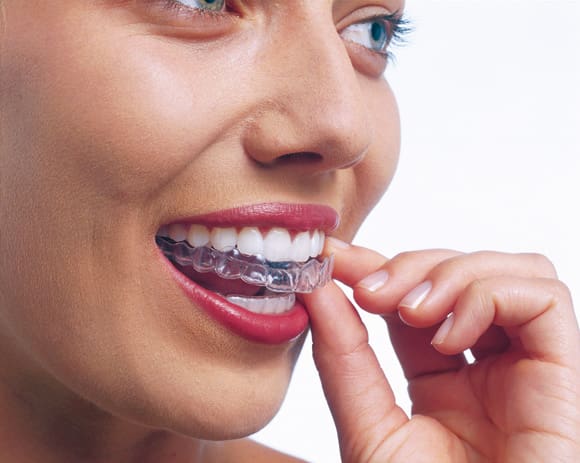 A woman places her Invisalign aligner